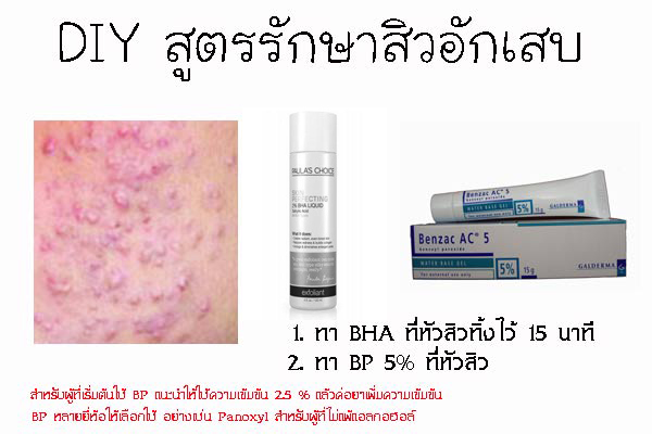 รักษาสิว