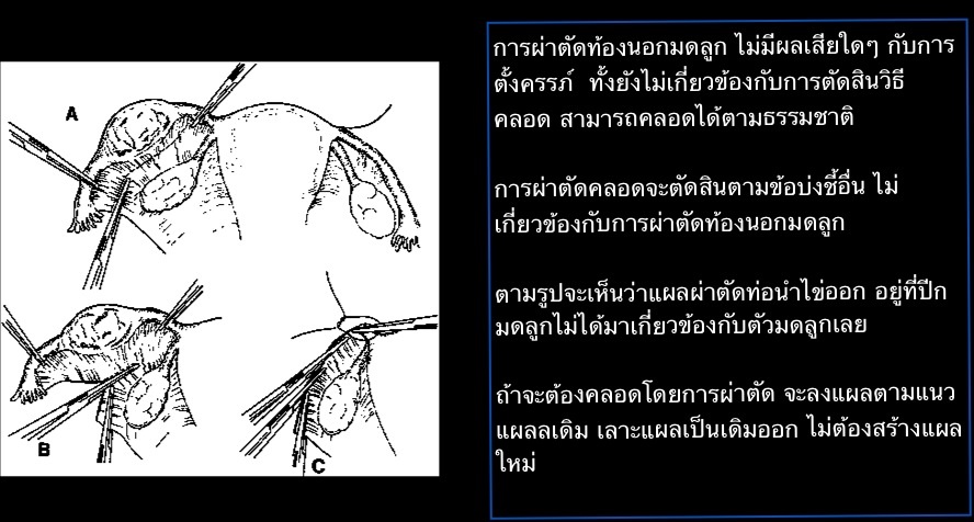 การตั้งครรภ์นอกมดลูก