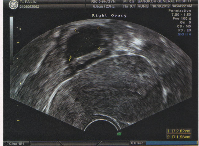 โรค PCOS