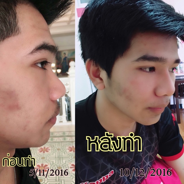 รีวิว การเสริมจมูก + ตัดปีกจมูก กับ คุณหมอวรรณา ที่โรงพยาบาลเลอลักษณ์ - Pantip รีวิว การเสริมจมูก + ตัดปีกจมูก กับ คุณหมอวรรณา ที่โรงพยาบาลเลอลักษณ์ - Pantip