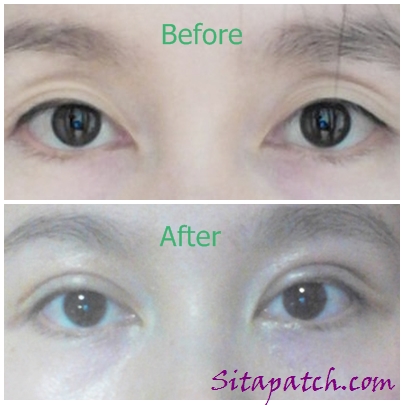 ทำตา 2 ชั้น แบบ Scarless Technic กับ หมอเกมส์ - Pantip ทำตา 2 ชั้น แบบ Scarless Technic กับ หมอเกมส์ - Pantip