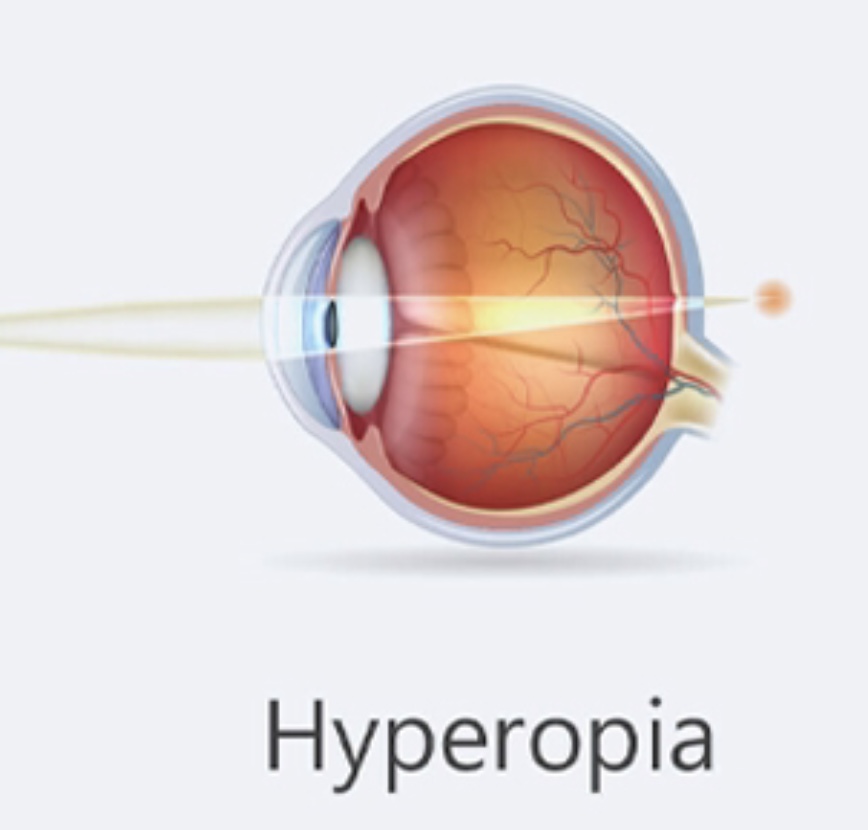Гиперметропия 1 степени глаз. Гиперметропия. Дальнозоркость. Аметропия это в офтальмологии. Гиперопия.