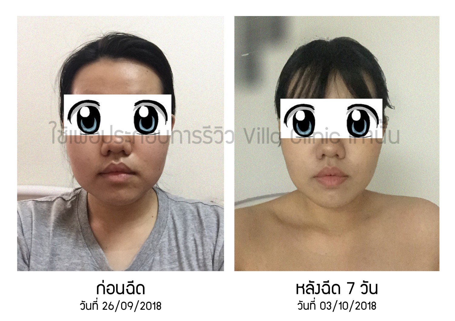 Meso Fat Filorga รีวิว Online