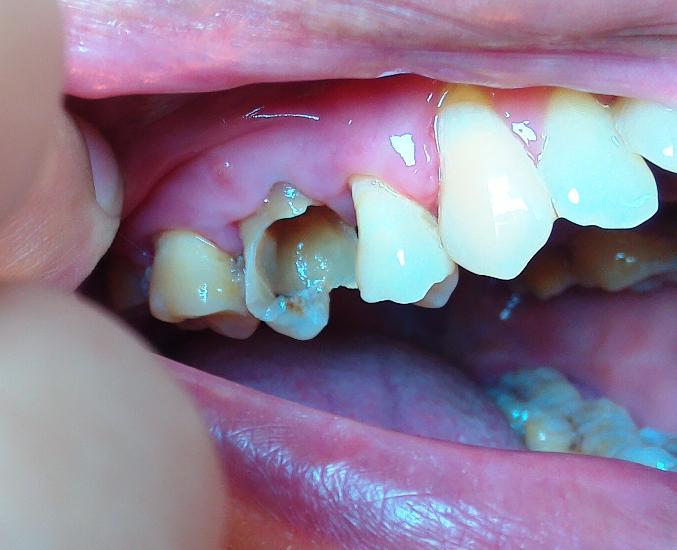 มีหนองในเหงือกที่บวมจากการอมน้ำเกลือเพื่อแก้ปวดฟัน  อย่างที่ทันตแพทย์หรือผู้รู้ทั้งหลายได้บอกเอาไว้จริง ๆ ด้วย - Pantip