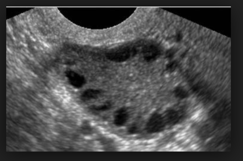 Спкя в гинекологии. Синдром поликистоза яичников на УЗИ. УЗИ мультифолликулярных яичников и СПКЯ. Синдром мультифолликулярных яичников на УЗИ. Поликистоз яичников снимки УЗИ.