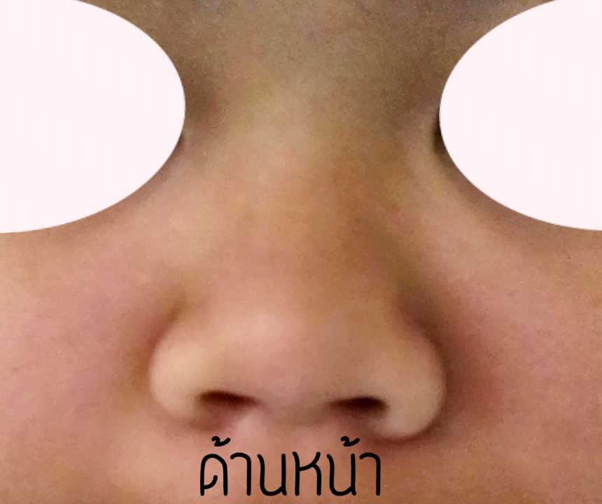 ดั้งแหมบมาก จมูกบาน ควรเสริมจมูกทรงไหนดีคะ ? (มีรูป) - Pantip