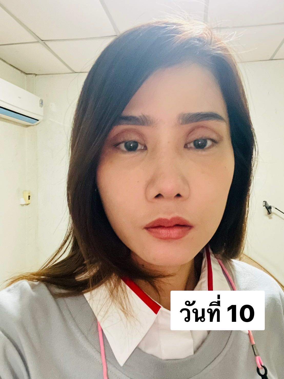 ทำตากับหมอชลธิศ แล้วชั้นตาลึกไปคะ - Pantip ทำตากับหมอชลธิศ แล้วชั้นตาลึกไปคะ - Pantip