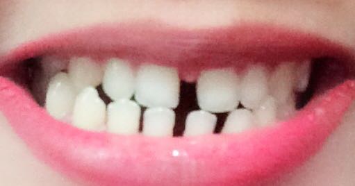 ฟันห่าง ดัดฟันประมาณกี่บาท - Pantip