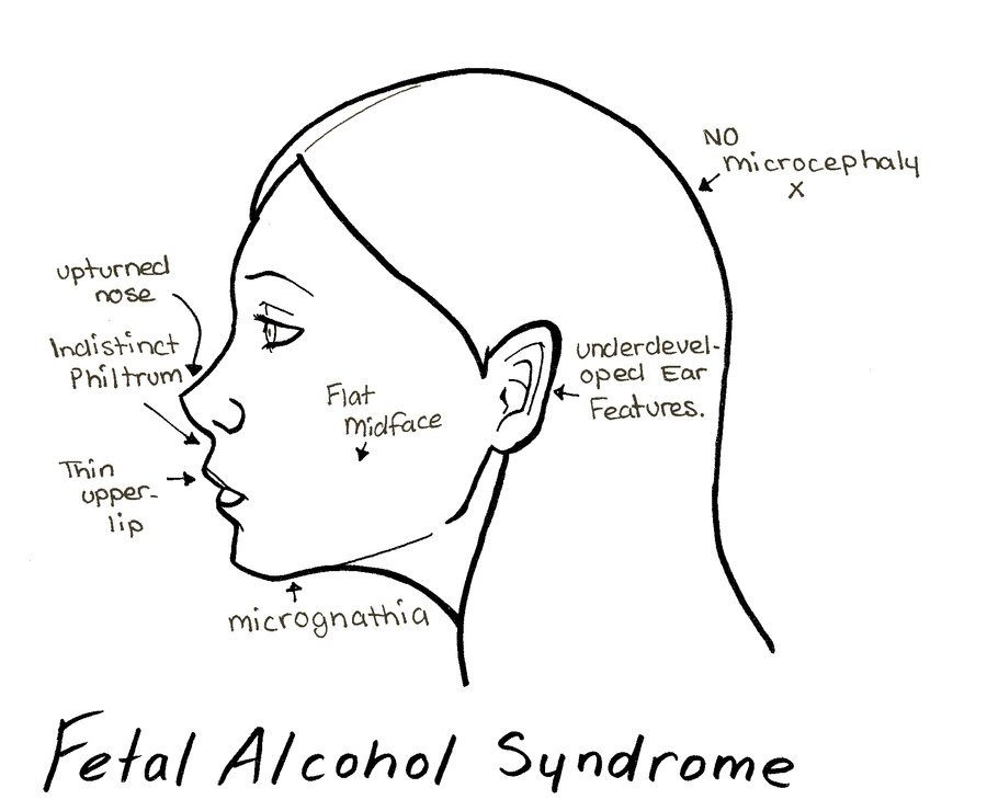 fetal alcohol syndrome (ค ว า ม ผ ด ป ก ต ข อ ง เ ด ก เ ม อ แ ม ต ด เ ห ล.....