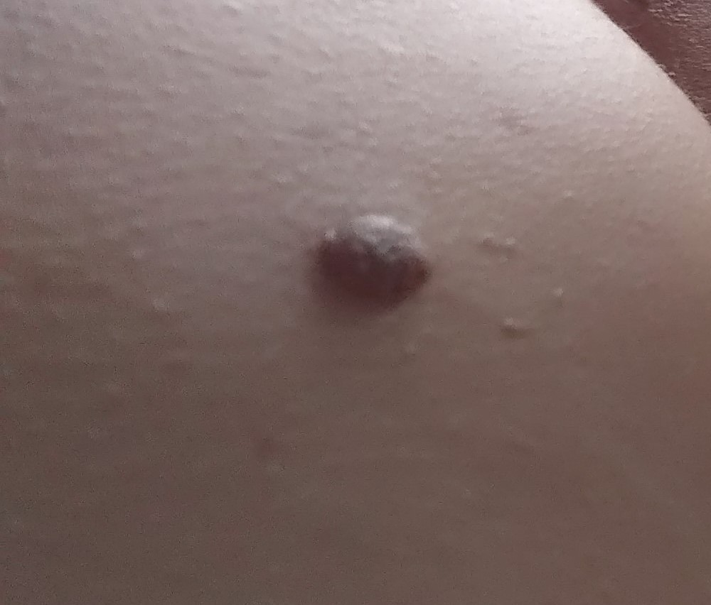 Skin tags on nipple during pregnancy