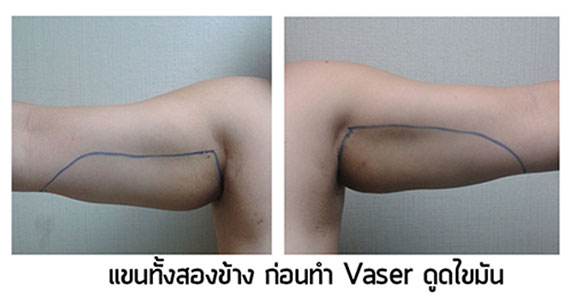 ดูดไขมัน Vaser Tite ต้นแขน+ต้นขา น้ำหนักลงไป20 กิโลค่ะ - Pantip