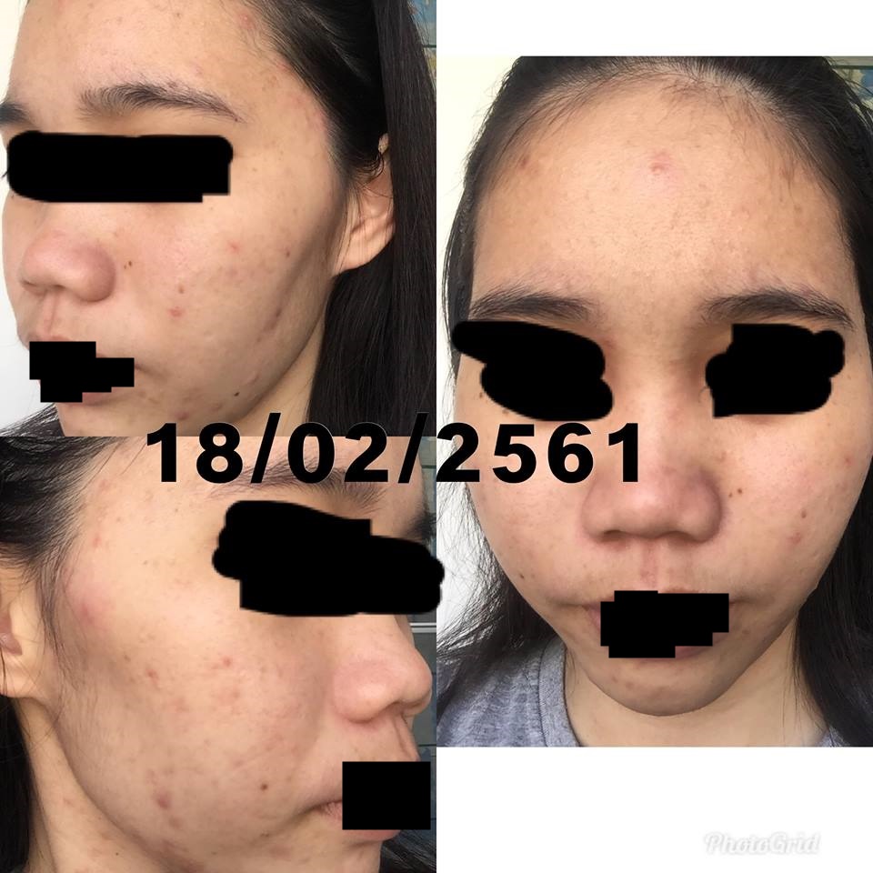 ร ว วสก นแคร ใช ร กษาส ว เม อฉ นเป นส วตอนป 1 หน กมาก 13 Pantip