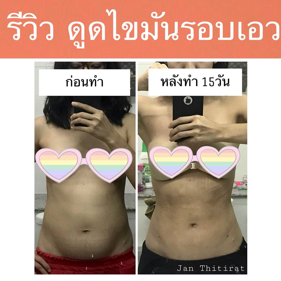 รีวิวดูดไขมันรอบเอว แบบ Body Tite พร้อมเคล็ดลับคืนชีพอย่างไวแบบติดจรวจ -  Pantip