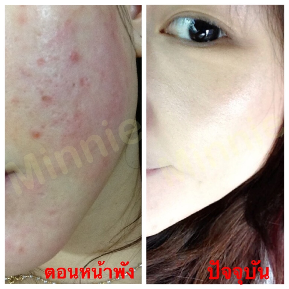 อุทาหรณ์ ครีมหน้าขาวใสมีสาร หน้าพัง!! - Pantip อุทาหรณ์ ครีมหน้าขาวใสมีสาร หน้าพัง!! - Pantip