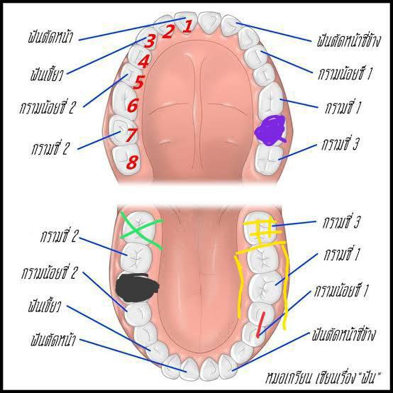 ถามทันตแพทย์]เรื่องรักษารากฟันครอบฟัน-ถอนฟันดี ?? (ฟันกรามบน) - Pantip