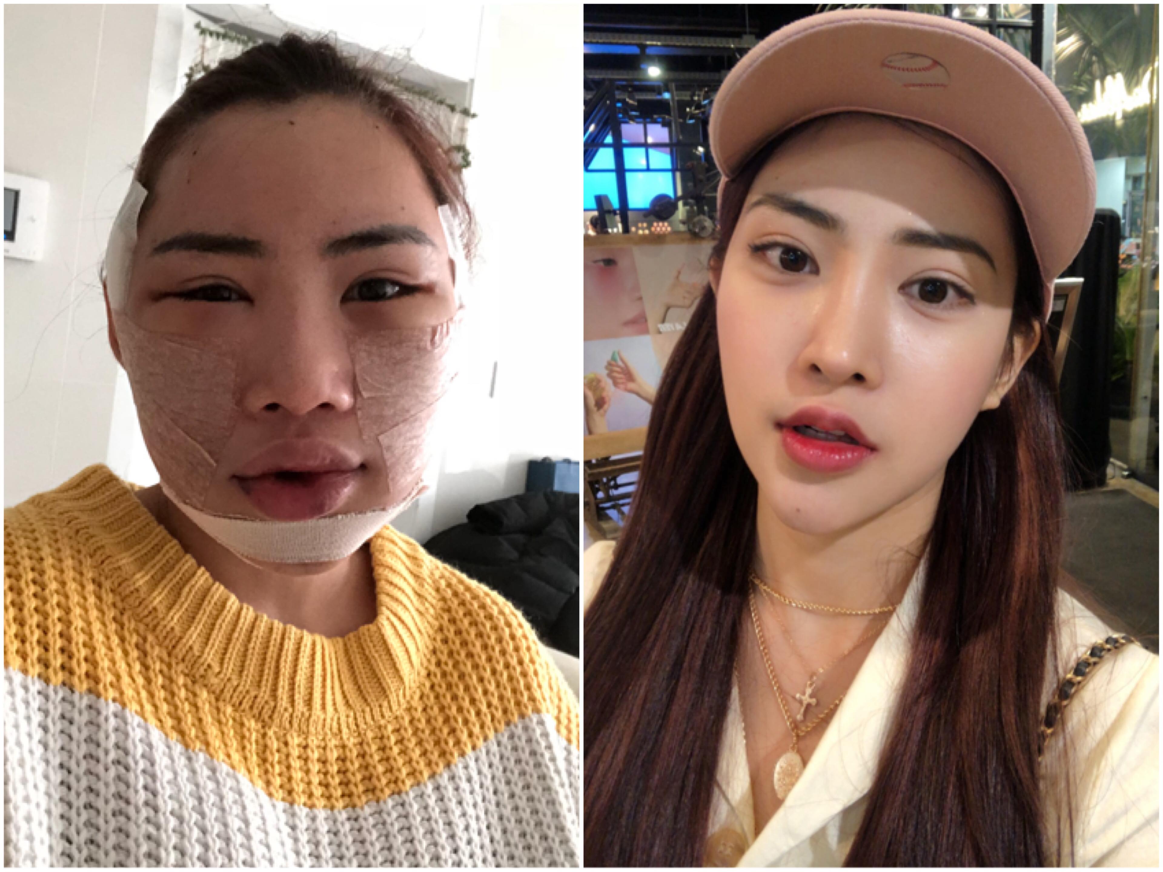 ศัลยกรรมเกาหลี : แปลงร่าง เป็นสาวสายเกา จนเพื่อนจำไม่ได้!!!!!!! รีวิวพลีชีพ  บอกเลยเจ็บแต่จบจริงๆค่าา++ - Pantip