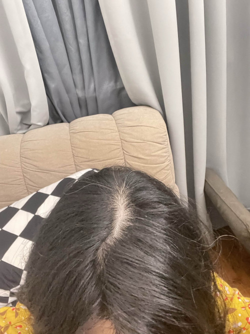 เป็นผู้หญิงผมบางและผมร่วงหนักมากจนหัวจะล้านอยู่แล้ว ทำยังไงดีคะ? - Pantip เป็นผู้หญิงผมบางและผมร่วงหนักมากจนหัวจะล้านอยู่แล้ว ทำยังไงดีคะ? - Pantip