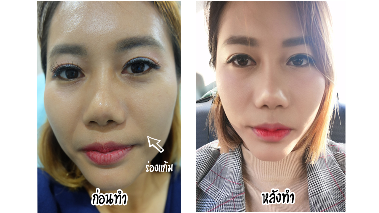 ฉีดฟิลเลอร์ร่องแก้มดีไหม ฉีดFillerครั้งแรกในชีวิตเห็นผลจริงมั้ย? - Pantip ฉีดฟิลเลอร์ร่องแก้มดีไหม ฉีดFillerครั้งแรกในชีวิตเห็นผลจริงมั้ย? - Pantip