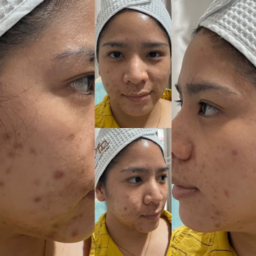 กู้สิวอักเสบด้วยแผ่นแปะสิว หายไวก่อนออกงานสำคัญได้ทันใจ! Curesys Heartleaf Acpair เอาอยู่ - Pantip กู้สิวอักเสบด้วยแผ่นแปะสิว หายไวก่อนออกงานสำคัญได้ทันใจ! Curesys Heartleaf Acpair เอาอยู่ - Pantip