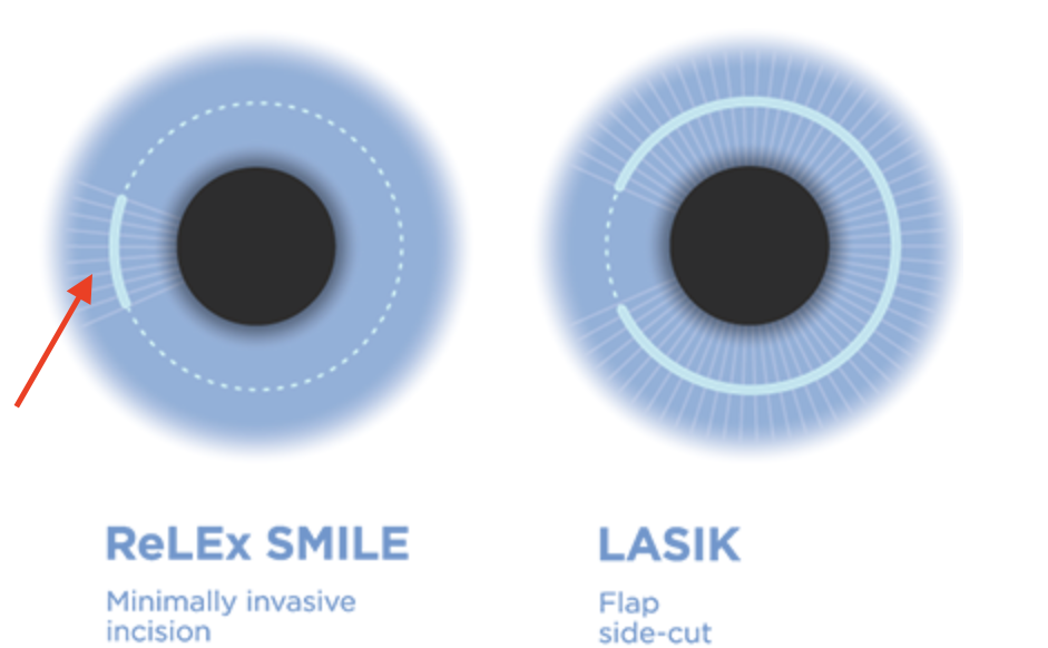 Коррекция зрения смайл цена со скидкой спектр. Разница Смайл и ласик. Лазерная коррекция зрения. Лазерная коррекция зрения LASIK. RELEX smile лазерная коррекция зрения.