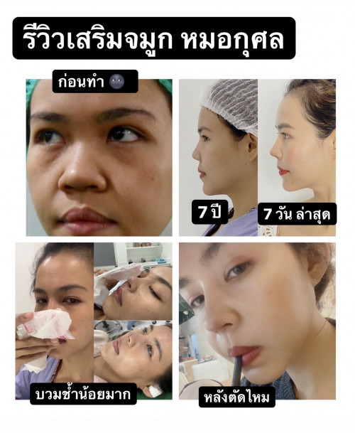 กระทู้พลีชีพ รีวิวเสริมจมูกกับหมอกุศล แพทย์เฉพาะทาง หู คอ จมูก ศิริราช -  Pantip