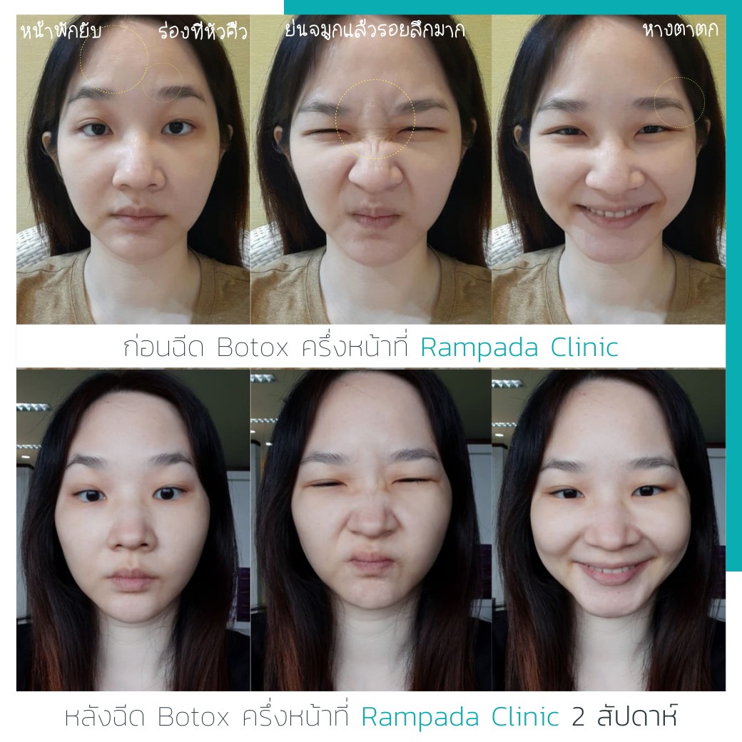 รีวิวฉีด Botox สัญชาติอังกฤษ Abo Active 3D Treatment บริเวณครึ่งหน้าบนที่  Rampada Skin Clinic - Pantip