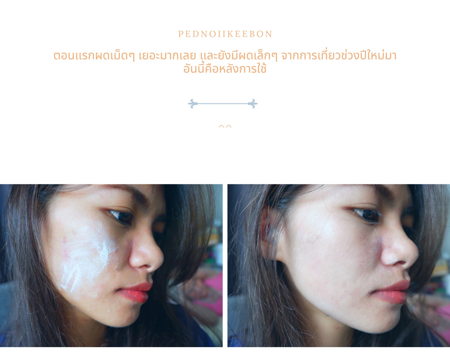 โฟมล้างหน้า acne aid website