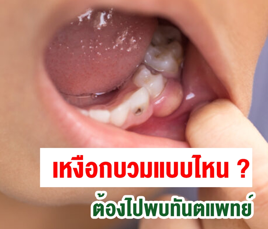 เหงือกบวมแบบไหน ? ต้องไปพบทันตแพทย์ - Pantip