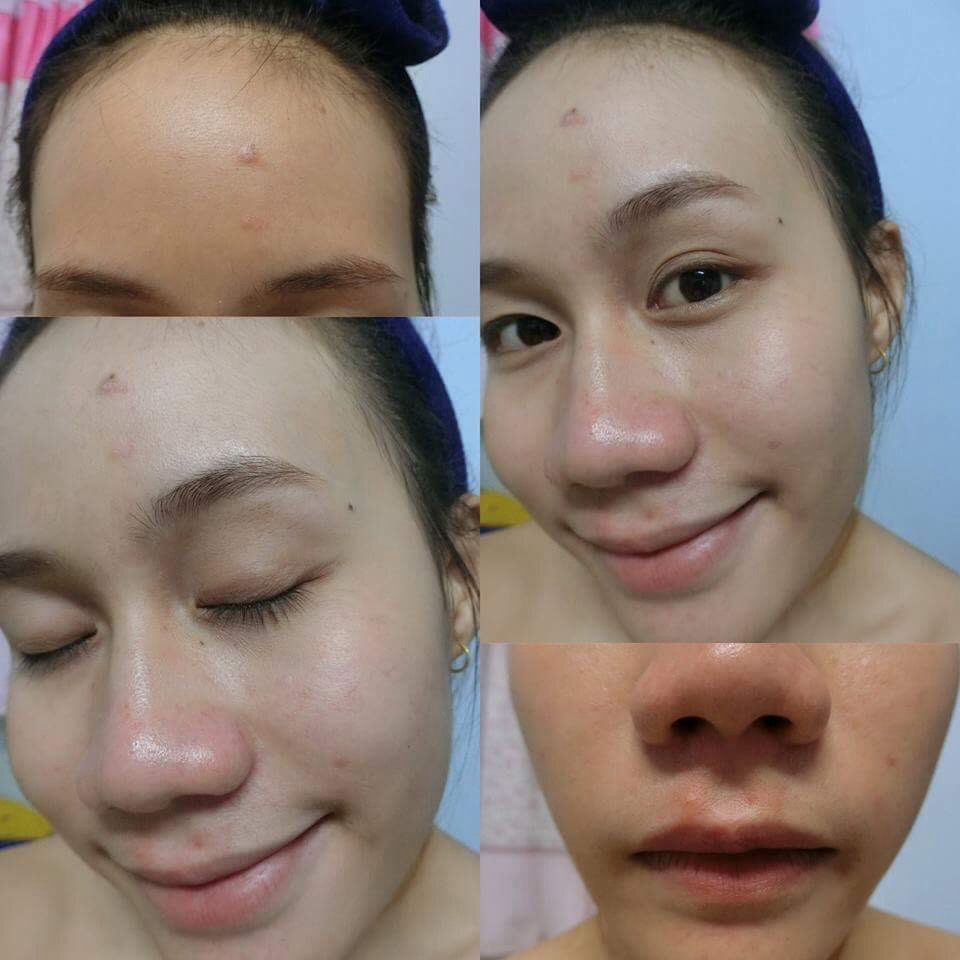 Reviw รักษาสิวด้วย tree tea oil. Pantip