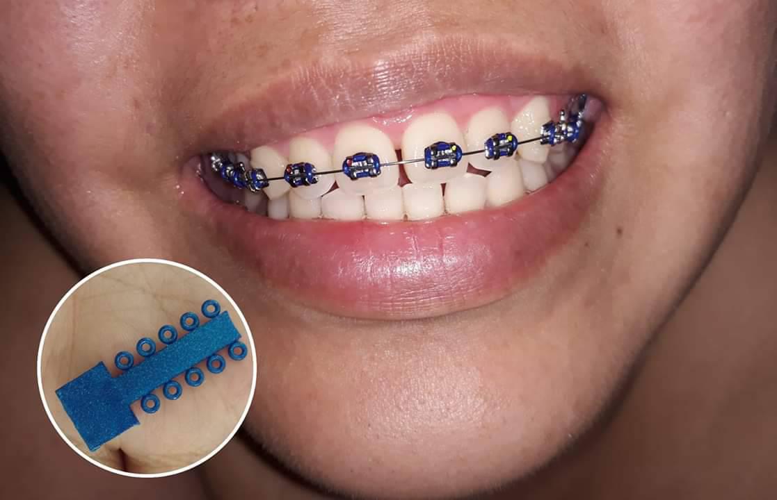 ไดอารี่การจัดฟัน แบบ Real Time (รูปเยอะ!) ของมนุษย์วัย 30 ปีที่เพิ่งอยากฟันดูดีแบบคนอื่นเขาบ้าง  - Pantip