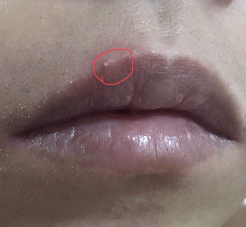 มีตุ่มขึ้นที่ปากแบบนี้เป็นสิวหรือเป็นเริมกันแน่คะ T T - Pantip