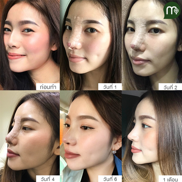 เสริมจมูก** หมอแม็ค ฟอร์จูน กับ หมออา เมโกะ ท่านไหนดีคะ - Pantip เสริมจมูก** หมอแม็ค ฟอร์จูน กับ หมออา เมโกะ ท่านไหนดีคะ - Pantip