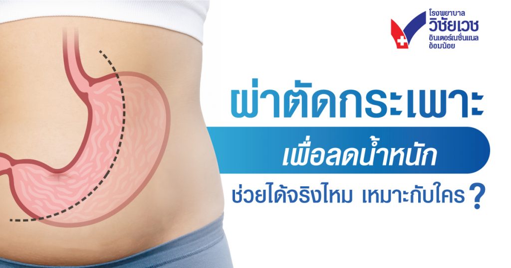 ผ่าตัดกระเพาะ เพื่อลดน้ำหนัก ช่วยได้จริงไหม เหมาะกับใคร? - 